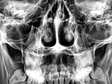 Sinus CT Scan